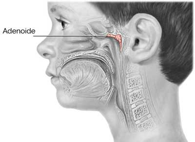 Adenoide