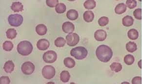 Anisocitose Anisocitose