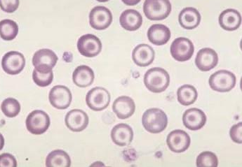 Poiquilocitose