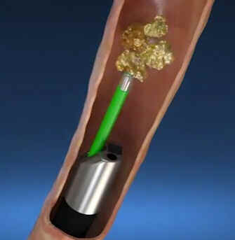 Ureteroscópio