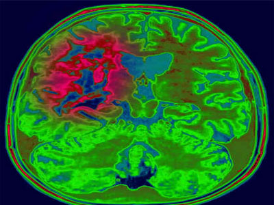 Glioblastoma