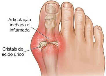 Hiperuricemia