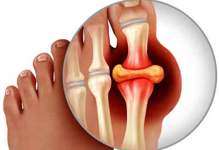 Hiperuricemia