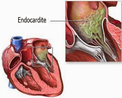 Endocardite Endocardite
