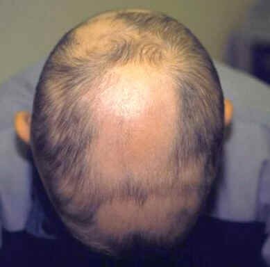 Alopecia areata