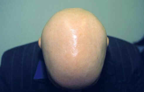 Alopecia areata