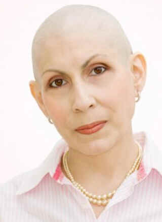 Alopecia areata