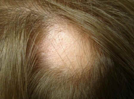 Alopecia areata