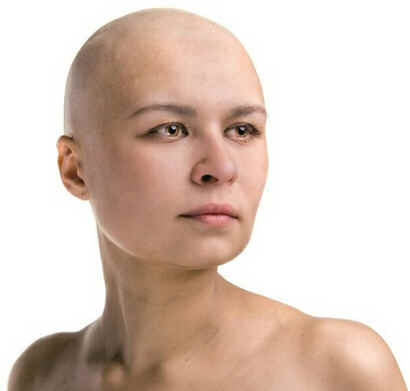 Alopecia areata