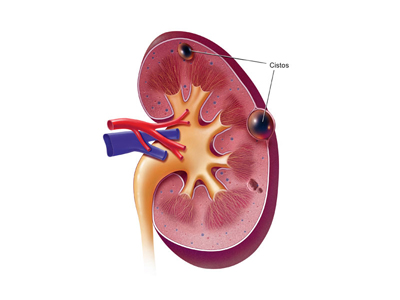 Cisto Renal