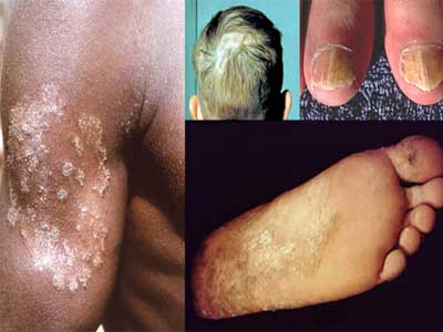 Dermatófitos