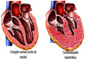 Hipertrofia cardíaca