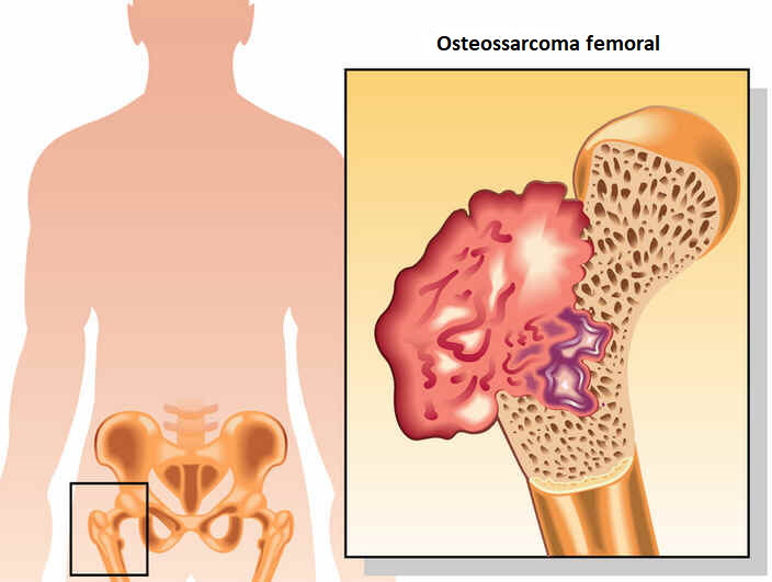 Osteossarcoma