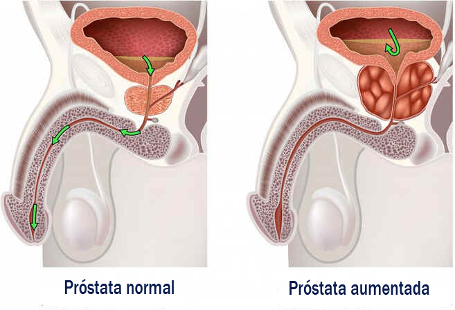 Próstata Próstata