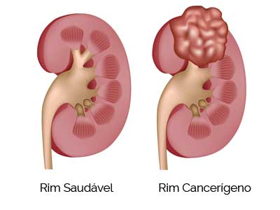 Adenoma Renal