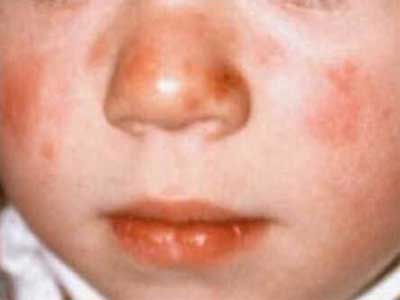 Lúpus Neonatal
