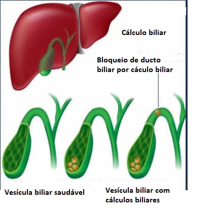 Bile Bile