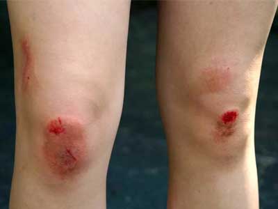 Anticoagulante