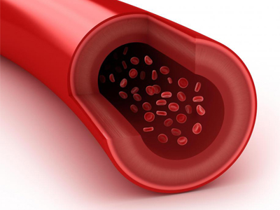Hiperlipidemia