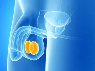 Varicocele