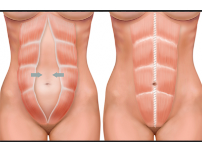 Diástase abdominal