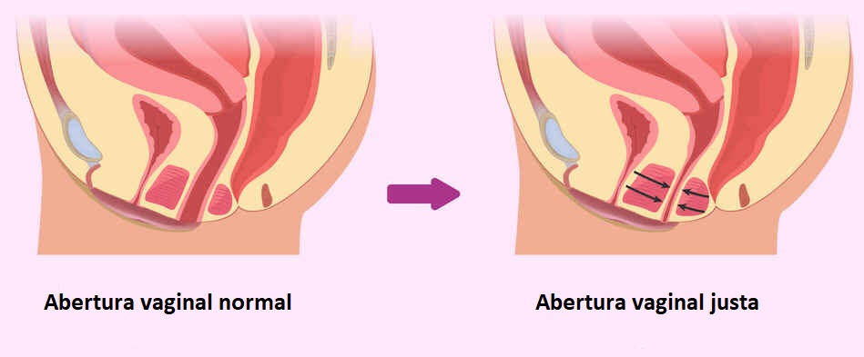 Vaginismo