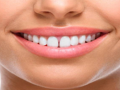 Diastema