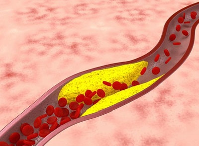 Hipercolesterolemia