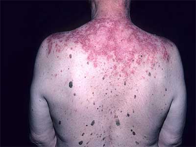 Lupus Vulgaris