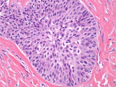 Tumor de Brenner