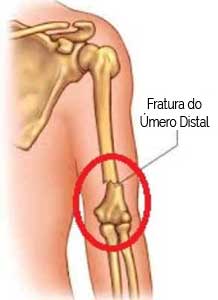 Fratura de Úmero