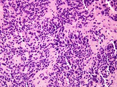 Neuroblastoma