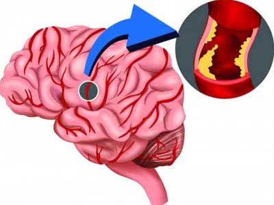 Trombose Cerebral