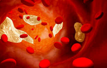 Hipercalcemia
