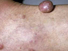 Xantoma