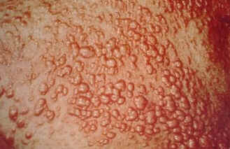 Xantoma