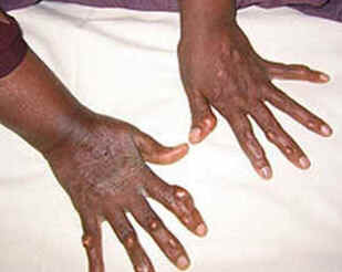 Xantoma