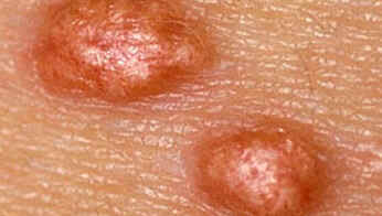 Xantoma