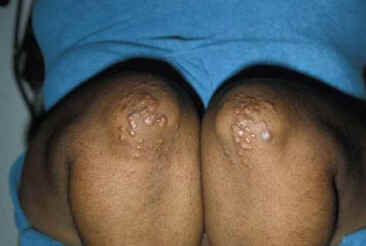 Xantoma