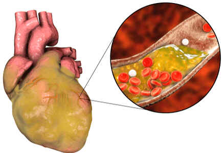 Hipertrigliceridemia