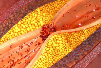 Hipertrigliceridemia
