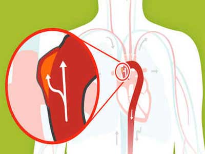 Aorta
