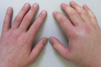 Edema