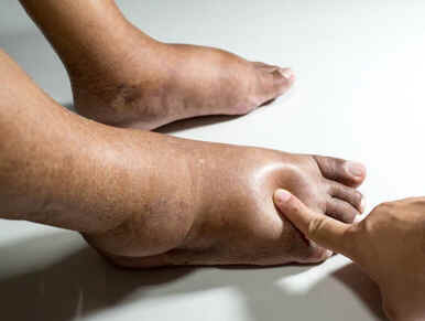 Edema