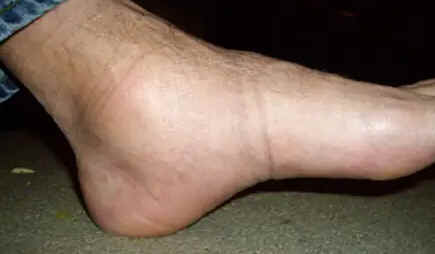 Edema