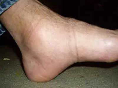 Edema