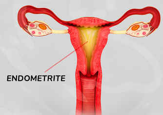 Endometrite