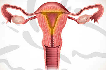 Endometrite