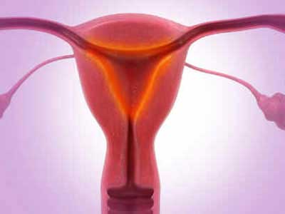 Endometrite