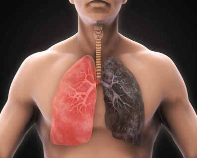 Enfisema